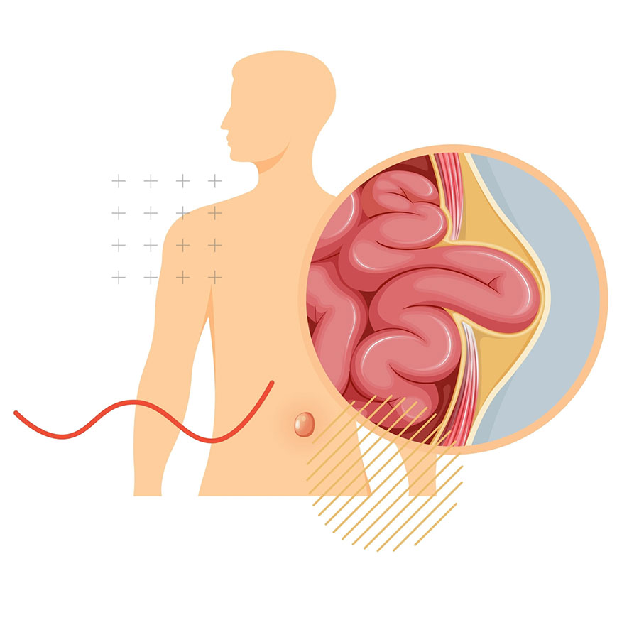 Inguinal and Umblical Hernias